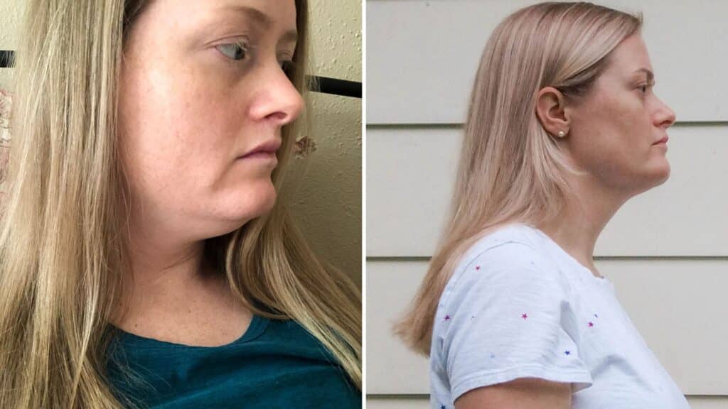 3 rounds of kybella before and after