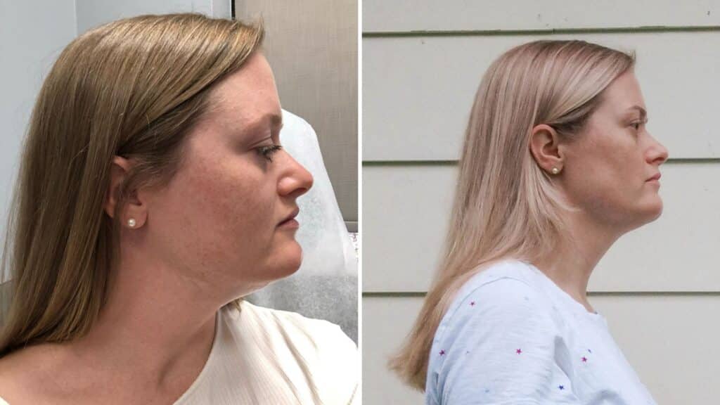 kybella before and after (with 3 rounds of kybella)