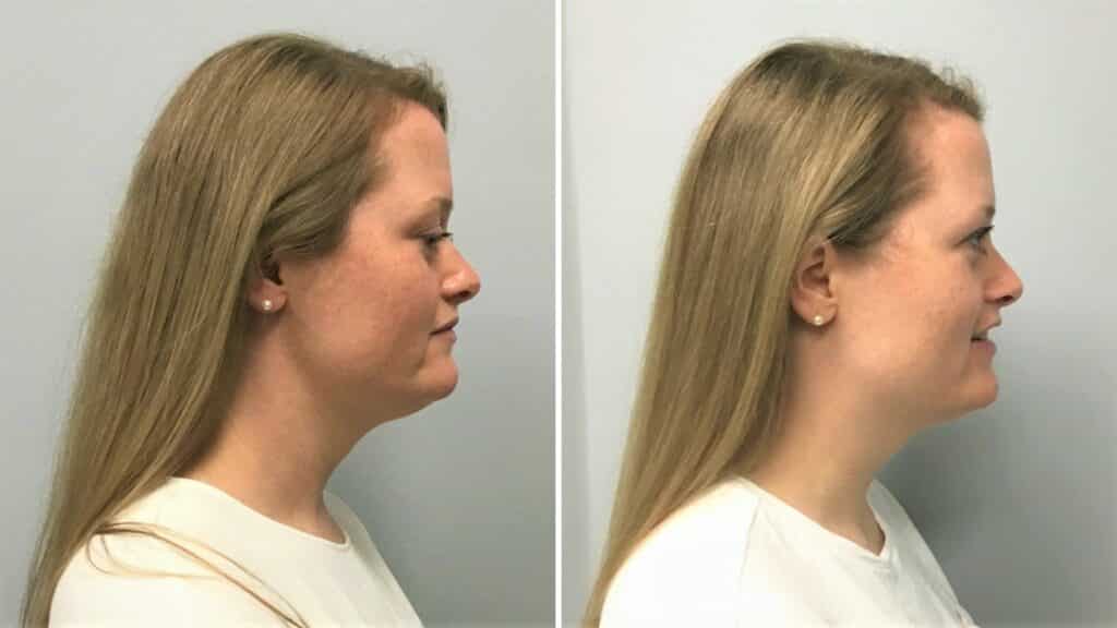 kybella before and after (3 rounds)