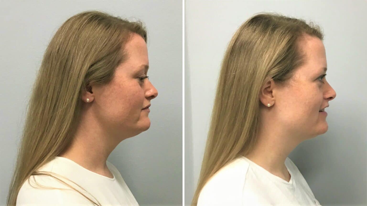 My Kybella Before and After How to Get Rid of Double Chin