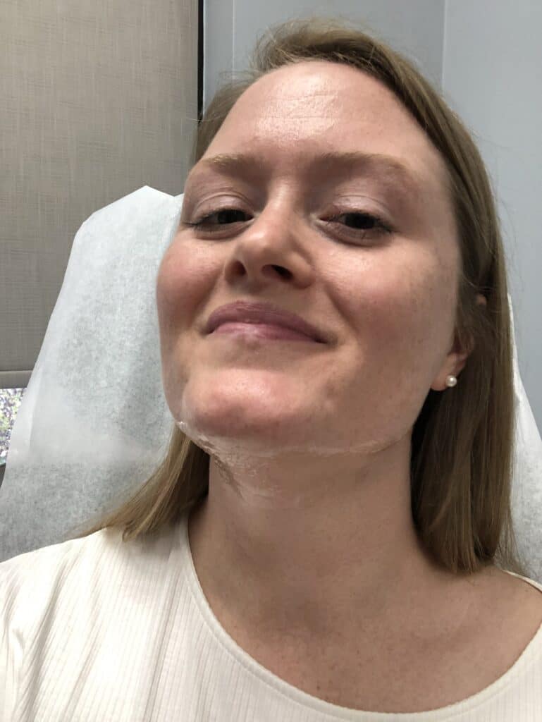 numbed and getting ready for Kybella to get rid of double chin