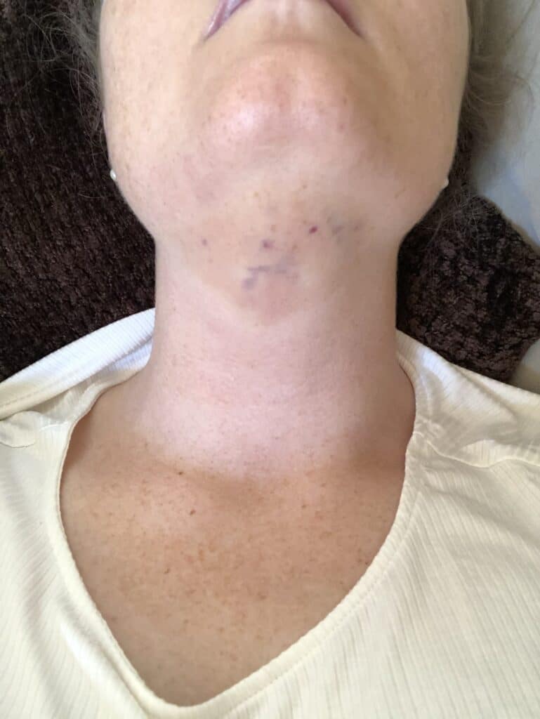 swelling after getting kybella treatment to get rid of double chin